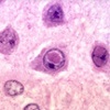 vacina-triplice-sarampo-virus